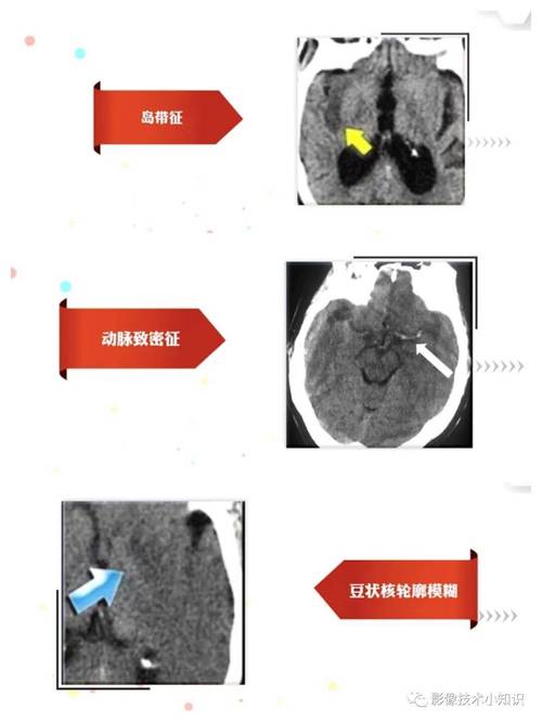 脑ct正常血压正常脑梗