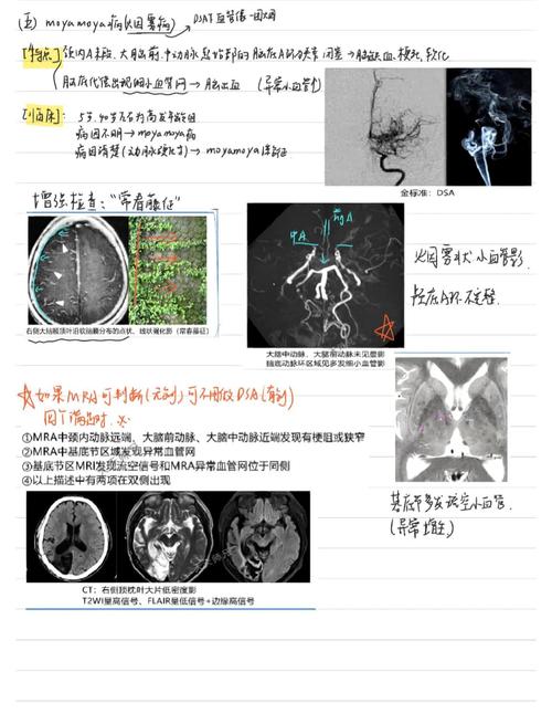 脑梗 脑ct查什么科室