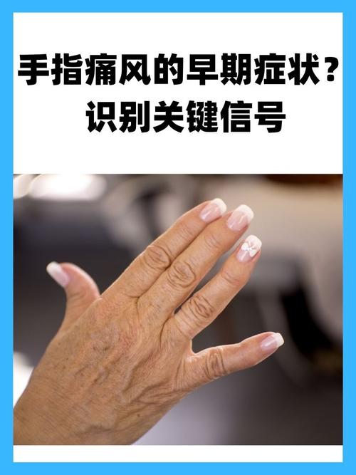 手指风湿类风湿怎么得的