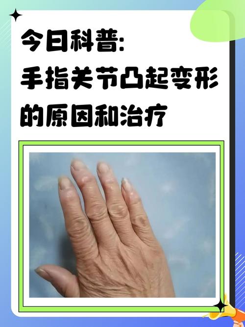 手指风湿类风湿怎么得的