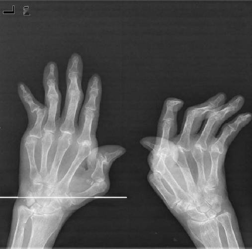 风湿类风湿拍片能看出吗