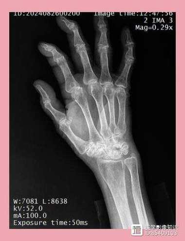 风湿类风湿拍片能看出吗