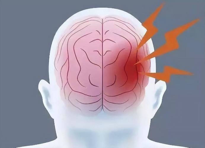 脑内散在腔梗就是脑梗吗