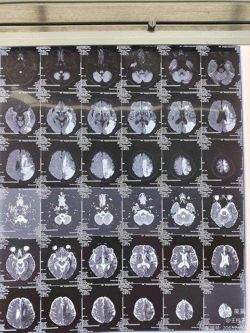 核磁新发脑梗和陈旧脑梗