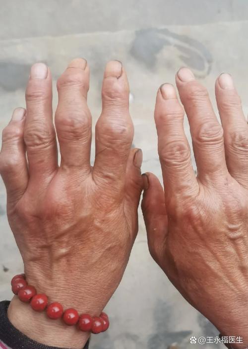 风湿及内风湿是什么症状