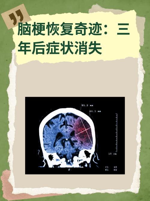 脑梗手术脑梗水肿期几天