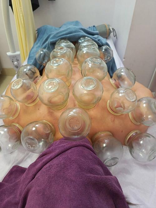 拔罐刮痧治疗风湿类风湿