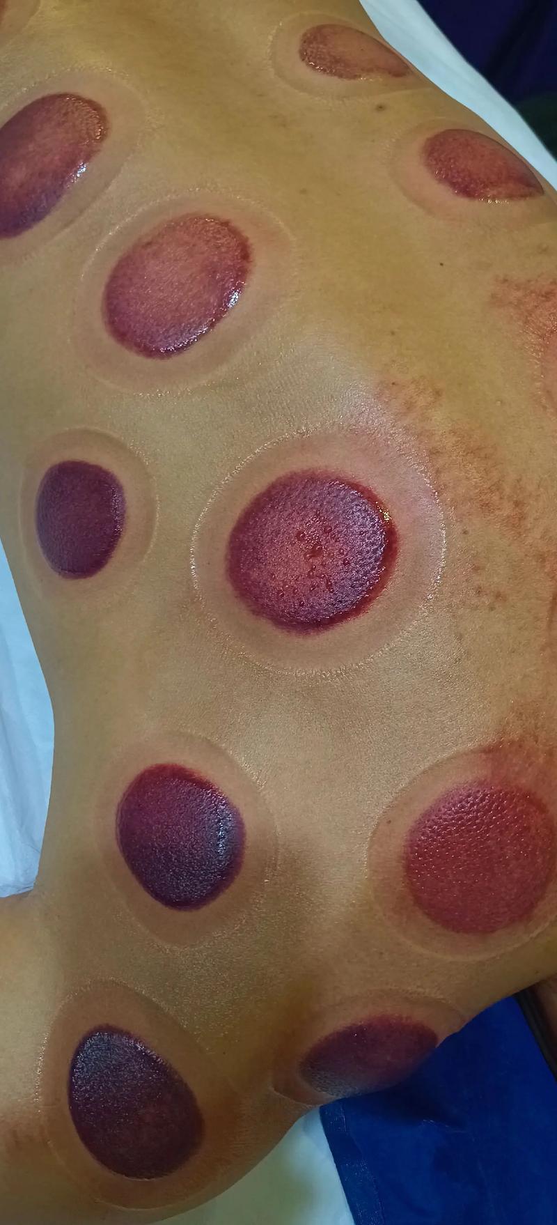 拔罐刮痧治疗风湿类风湿