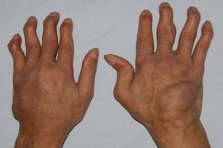 风湿类风湿有图片看看吗