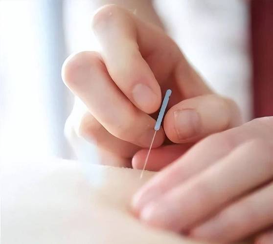 手风湿类风湿的针灸图片