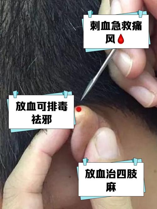 眼底出血针灸什么穴位