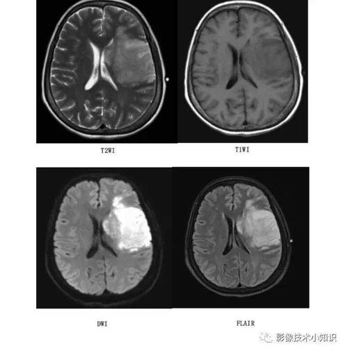 轻微脑梗做ct还是核磁