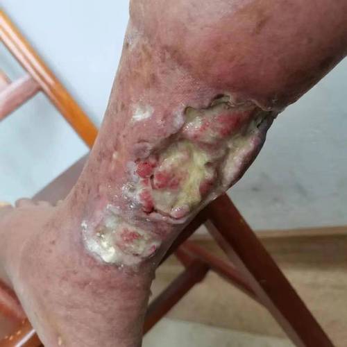 狼疮属于风湿还是类风湿