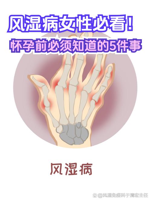 狼疮属于风湿还是类风湿