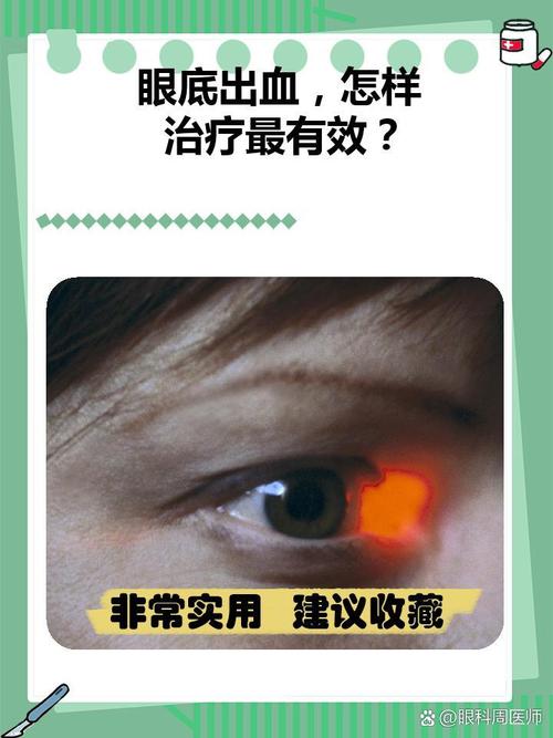 眼底出血和脑梗有关系吗