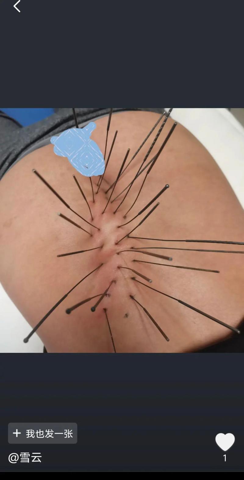 治疗腰椎滑脱针灸穴位