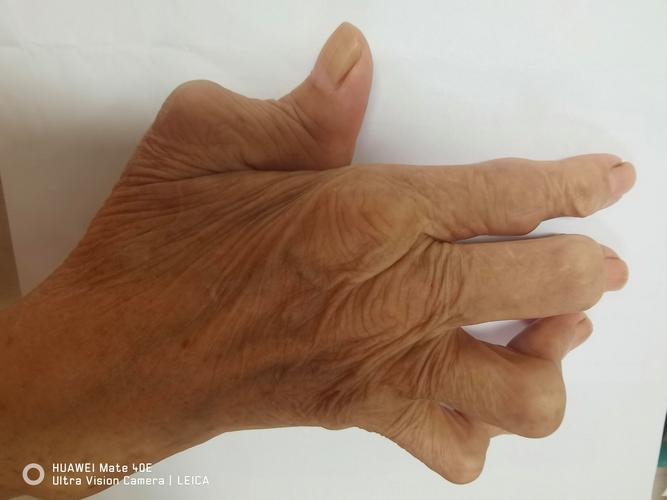 类风湿早期风湿因子阴性