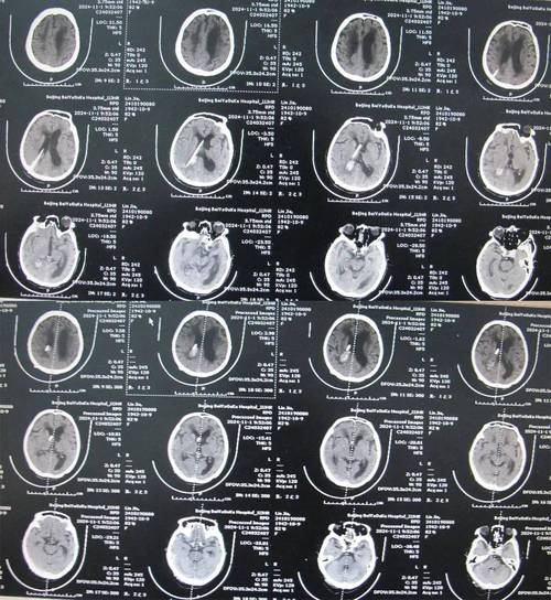 头部ct能检查出脑梗吗