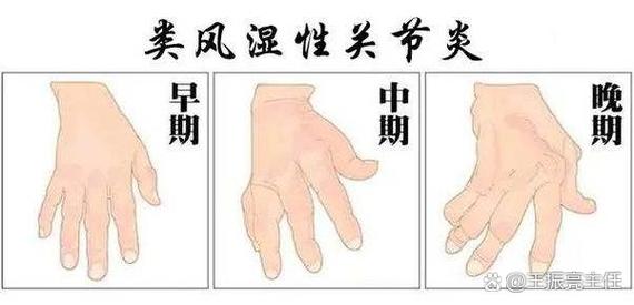 小孩风湿类风湿怎么确诊