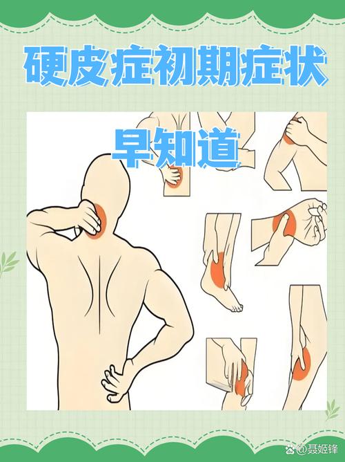 硬皮病是风湿还是类风湿