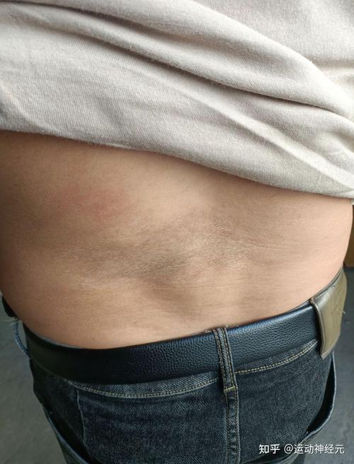 硬皮病是风湿还是类风湿