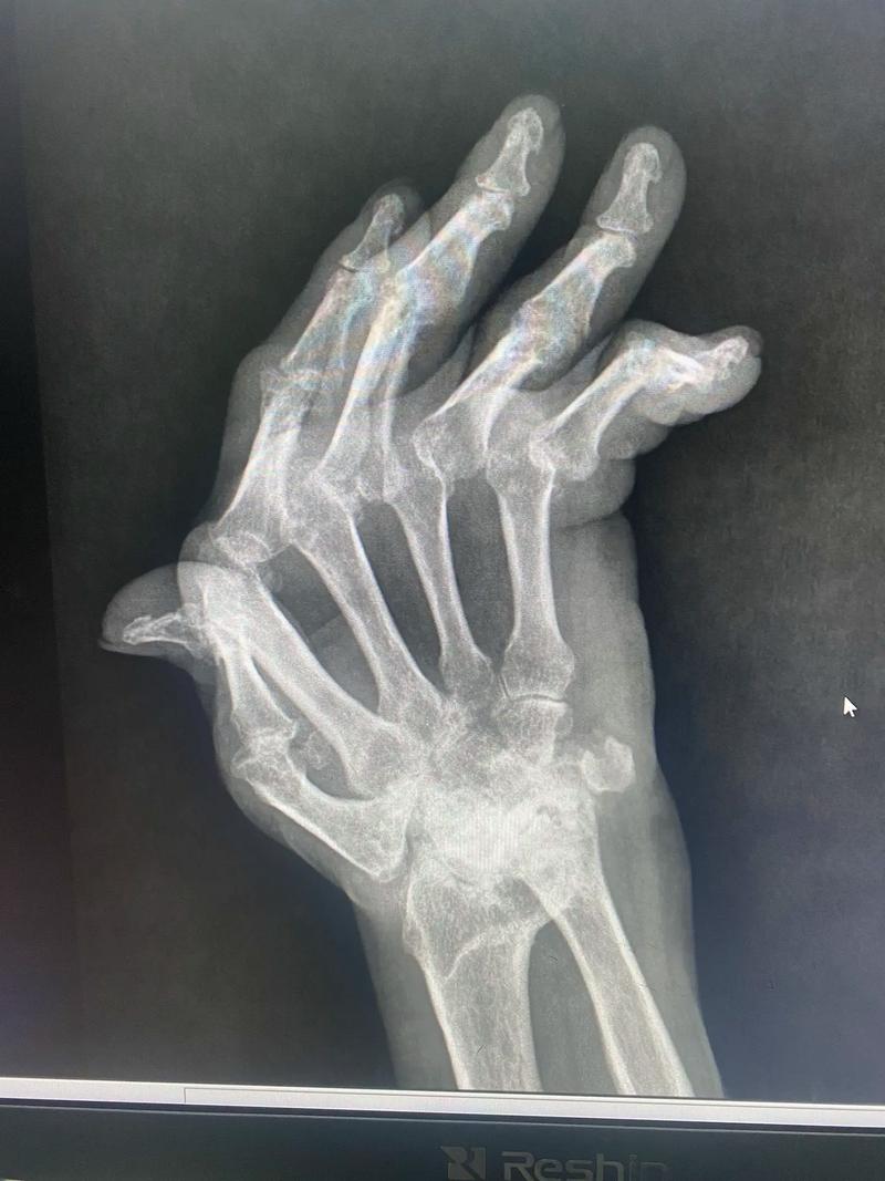 风湿类风湿骨骼变形图片