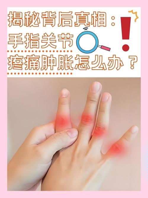手指肿 风湿还是类风湿