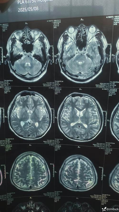 左半边头疼 风湿类风湿
