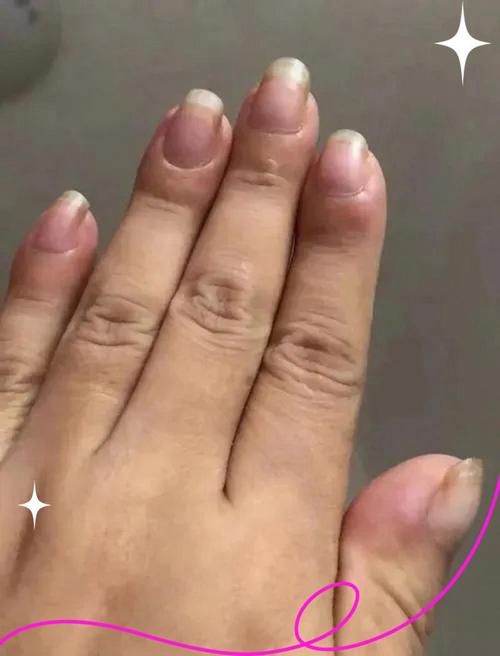 风湿类风湿记者调查暗访