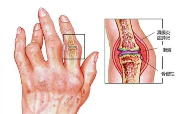 骨关节炎和类风湿关节炎