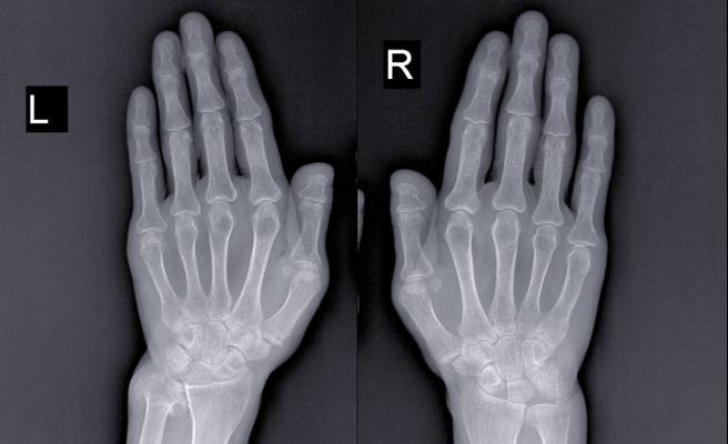 类风湿性关节炎影像表现