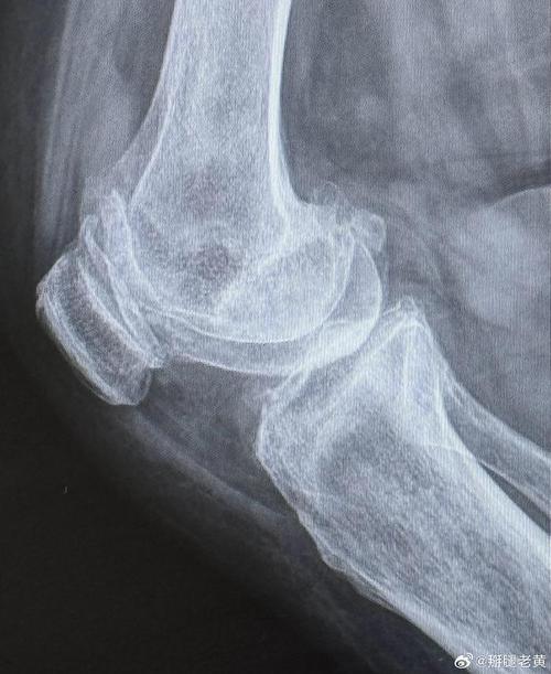 类风湿性关节炎影像表现