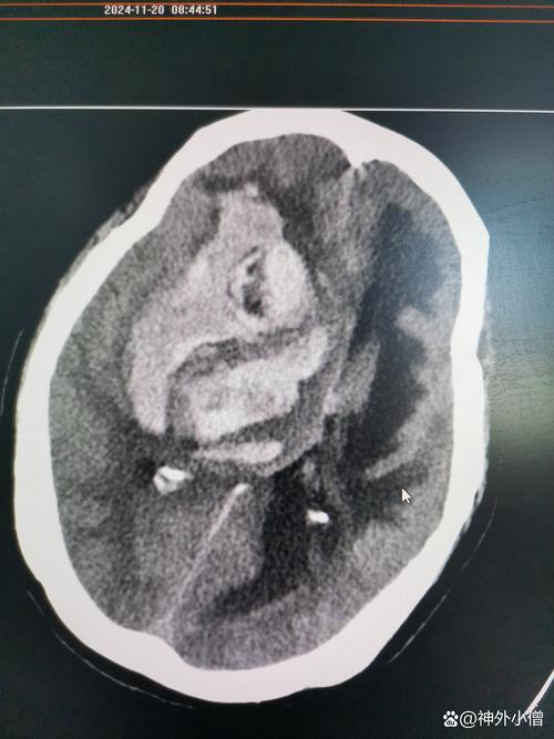 脑梗出血积液脑干变形