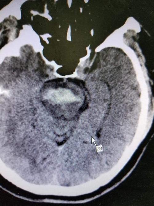 脑梗出血积液脑干变形