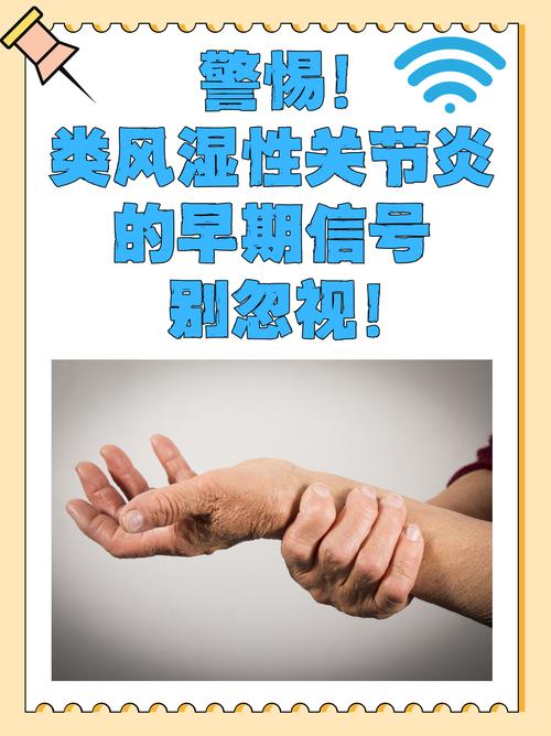 类风湿性关节炎临床诊断