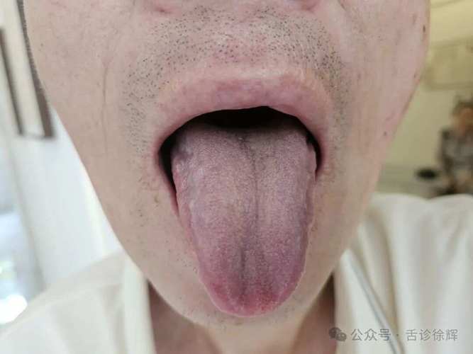 脑梗脑干堵塞舌根后辍