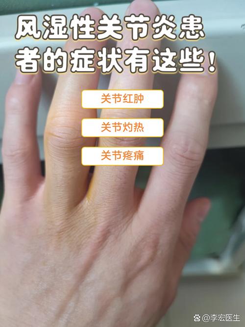 类风湿性关节炎急性发作