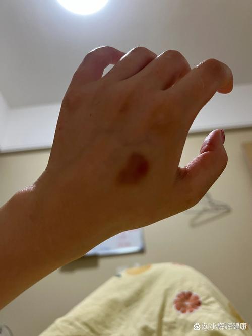 脑梗后手麻木并有淤血