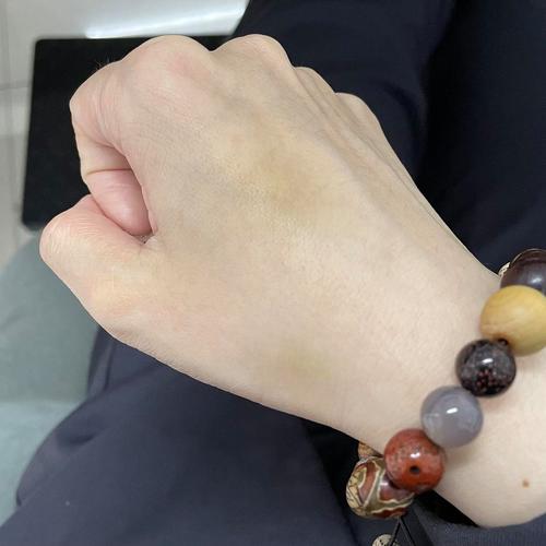 脑梗后手麻木并有淤血