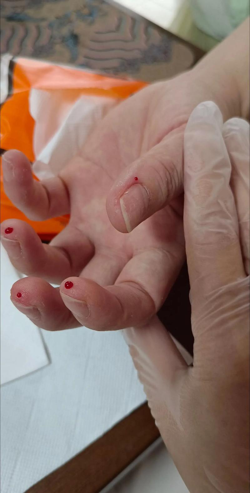 脑梗后手麻木并有淤血