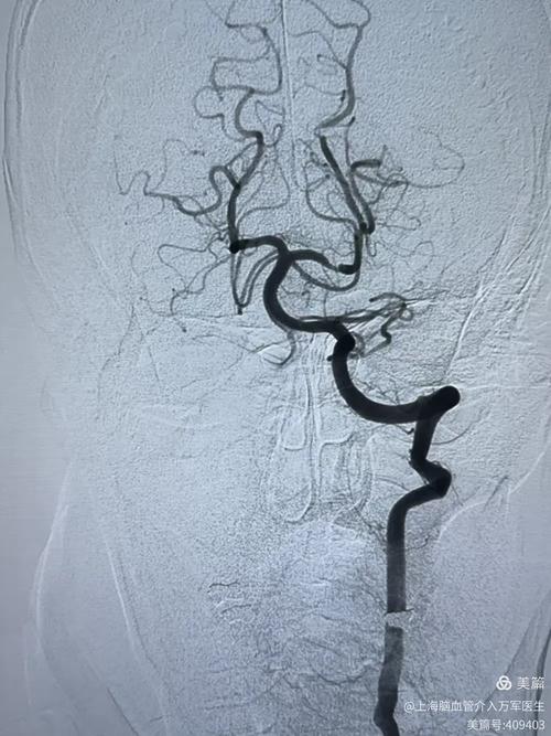 脑梗患者多处血管狭窄