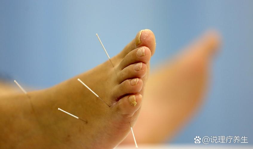 脑梗病人脚底针灸理疗