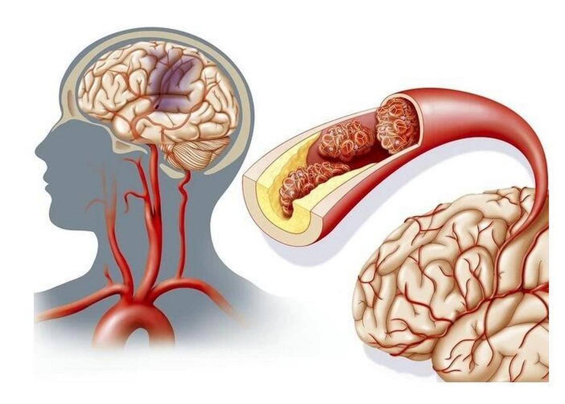脑梗合并心衰临死状态