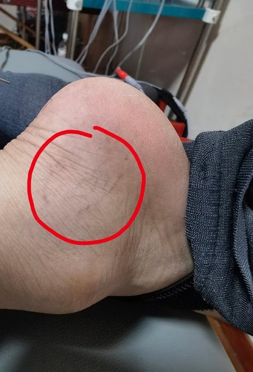 腿脚不适属于轻微脑梗