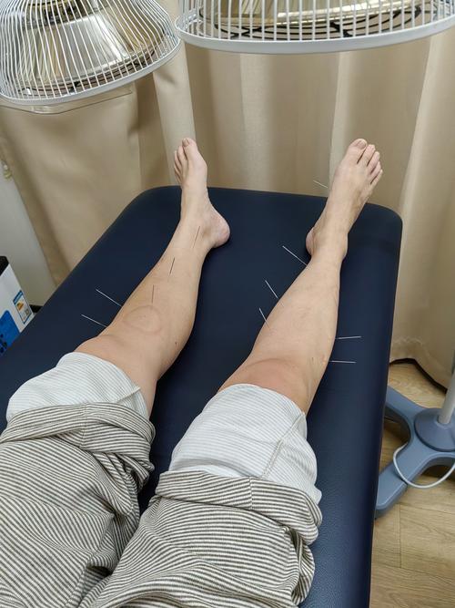 类风湿关节炎的针灸治疗