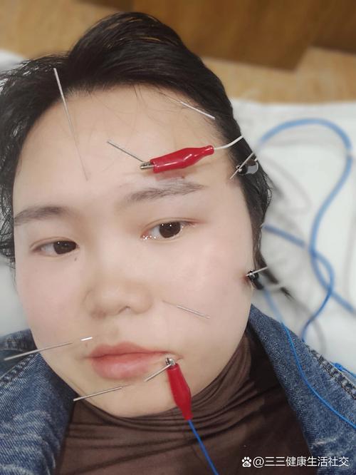 针灸治疗面瘫面部穴位