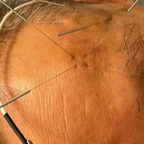 针灸治疗面瘫面部穴位