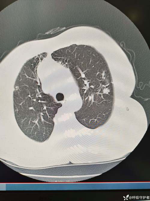 脑梗开颅手术肺部感染