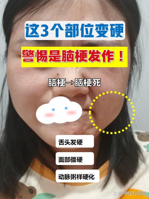 脑梗 不会说话 识字