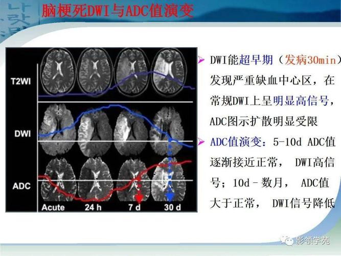 急性脑梗磁共振ppt